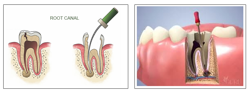 Root Canal in shalimar bagh