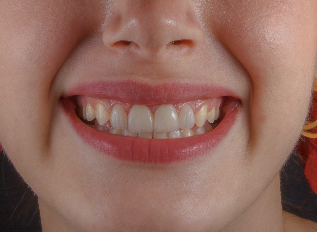 Close-up of a smile illustrating clear aligner treatment